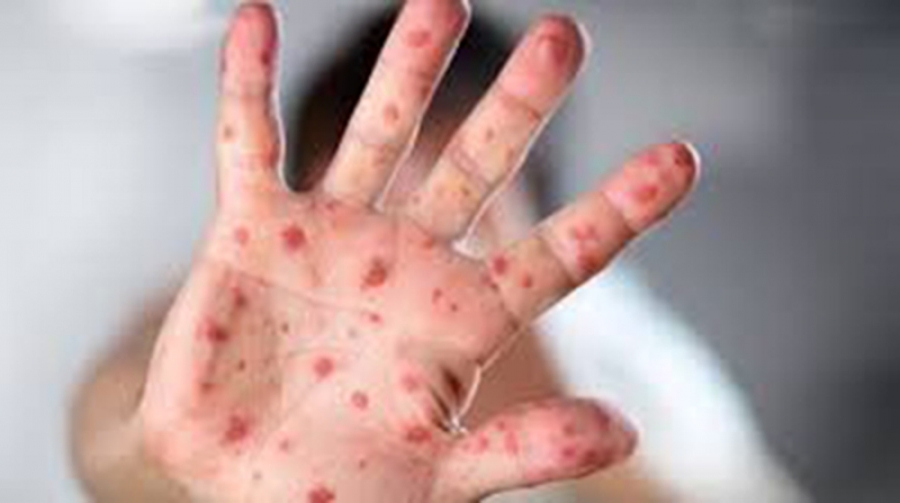 Cooks ‘safe’ from measles
