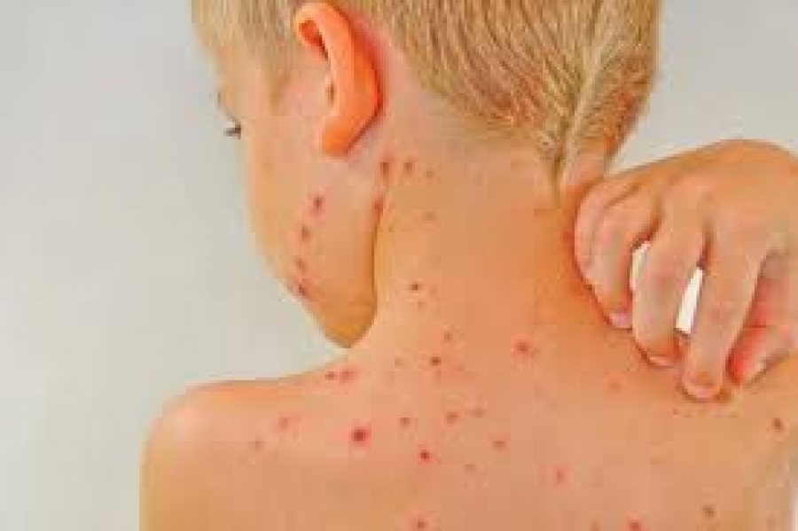 New rash of chickenpox cases widens